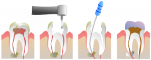 root canal treatment bentleigh