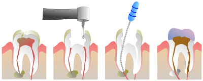 root canal treatment bentleigh